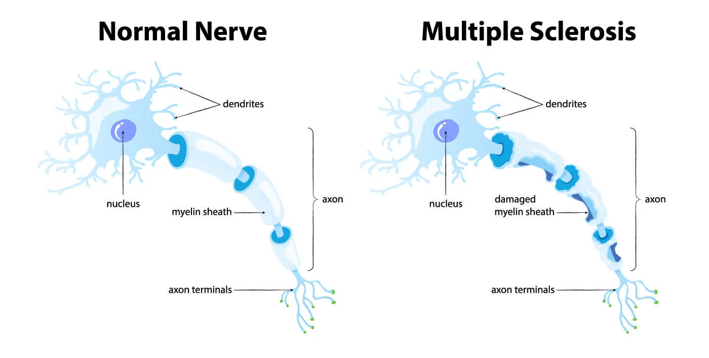 normaler Nerv vs. Multiple Sklerose